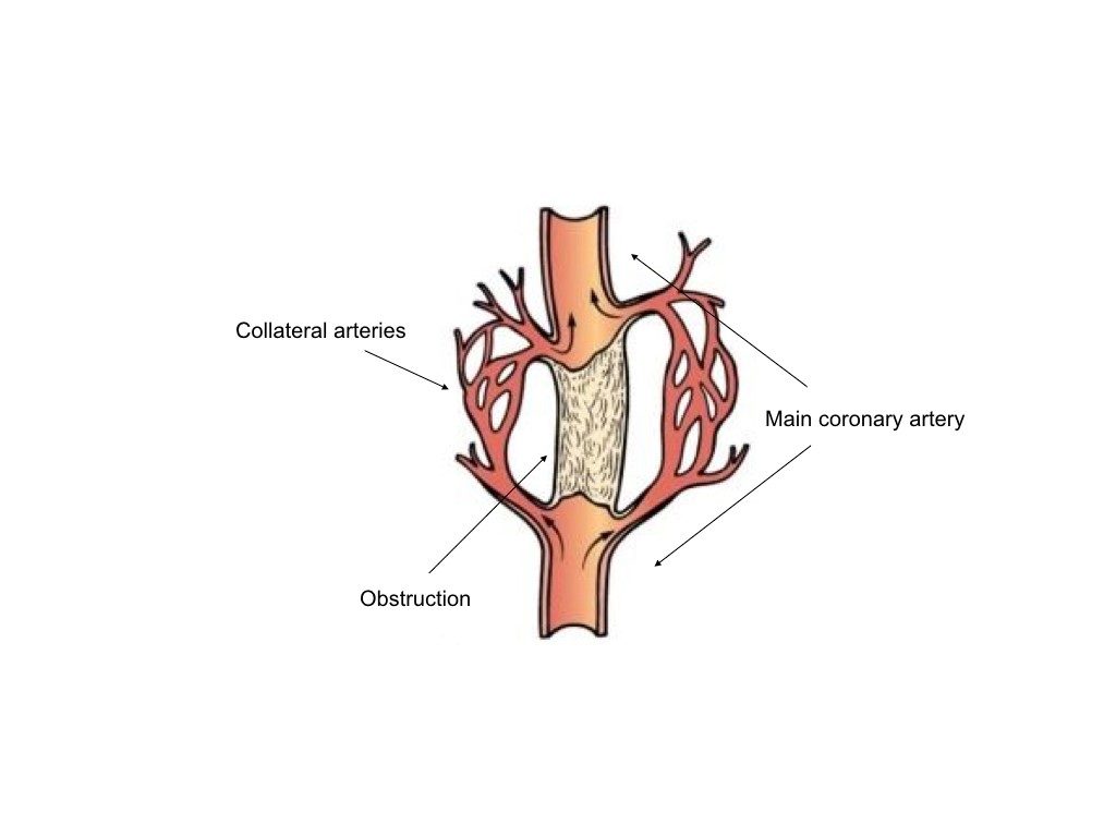 Diagram showing the collateral arteries forming a bypass to restore blood flow below an obstruction.