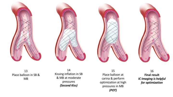 Bifurcations: From An Interventional Cardiologist’s Perspective