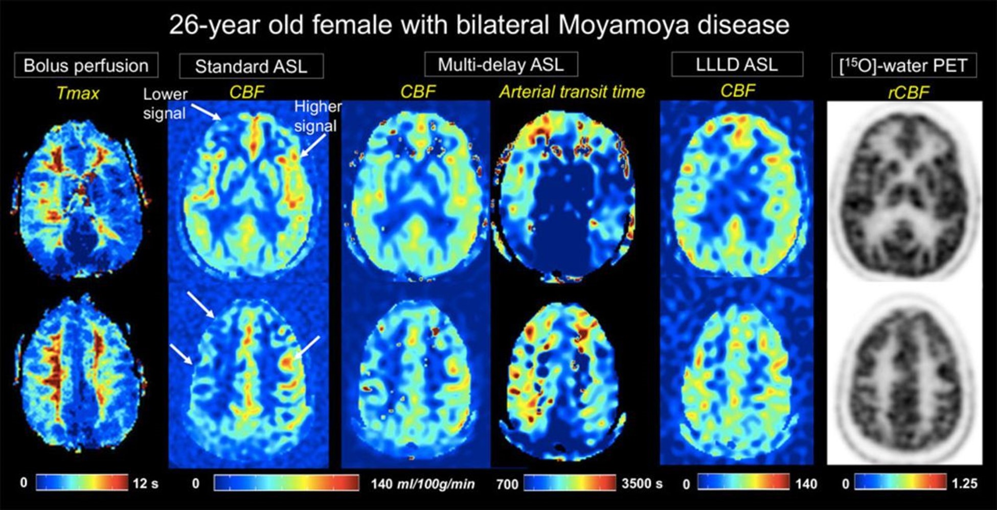 Medical Imaging – the Window to the Brain of Moyamoya Disease Patients